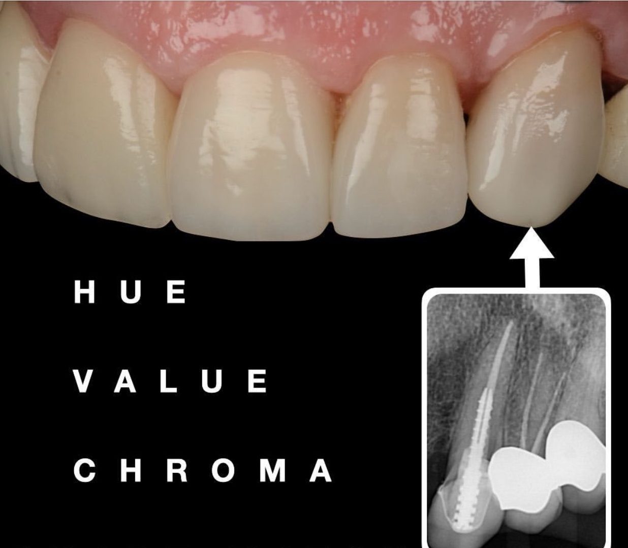 Emax Crowns