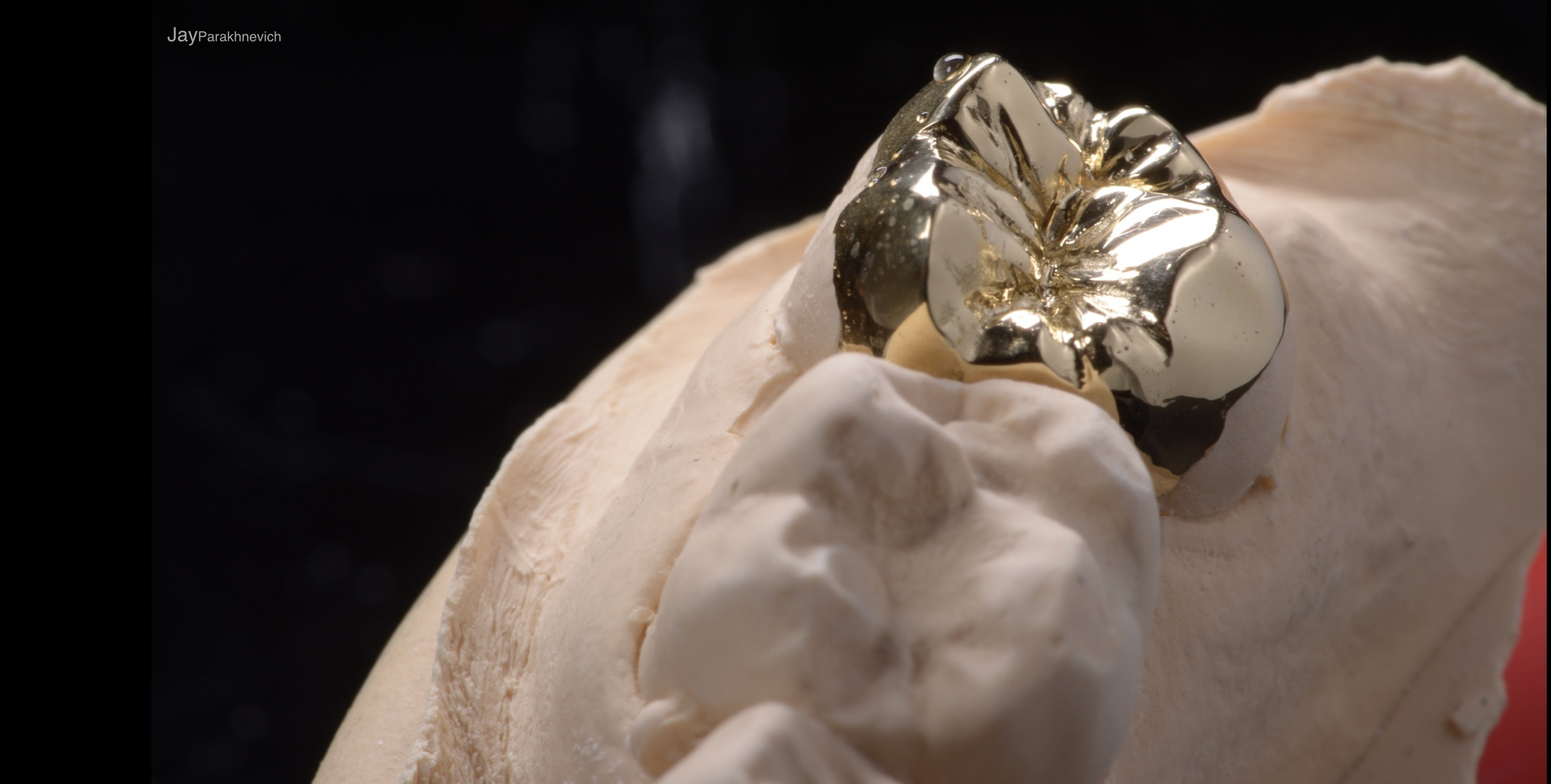 Gold Restorations