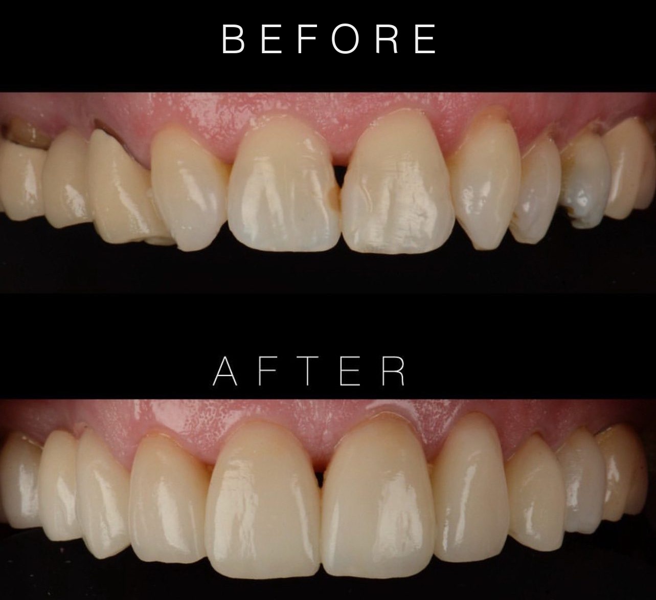 Porcelain Laminates before and after